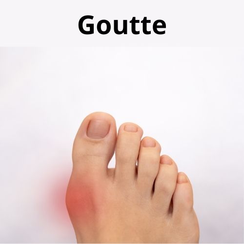 Les compl&eacute;ments alimentaires et les plantes pour stopper les crises de goutte.